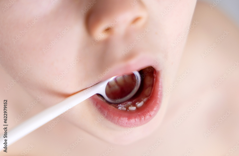 Naklejka premium kid boy with shark teeth. permanent adult teeth coming behind adult one, double row.child with diastema gap between. close up mirror mouth using, dental care dentist close up