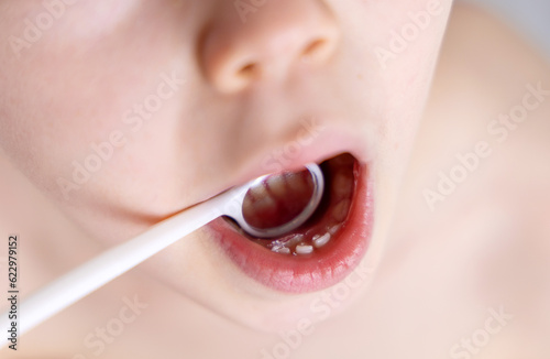 kid boy with shark teeth. permanent adult teeth coming behind adult one, double row.child with diastema gap between. close up mirror mouth using, dental care dentist close up