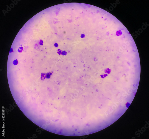 malaria parasite plasmodium falciparum on a thick blood smear reading under a microscope photo