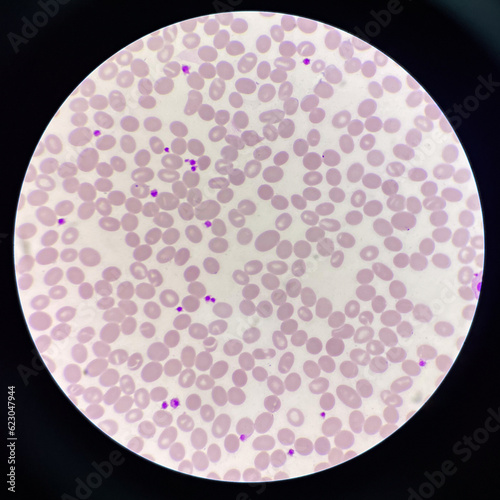 Abnormal cell macro ovalocyte. photo