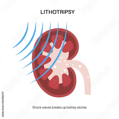 Lithotripsy procedure concept