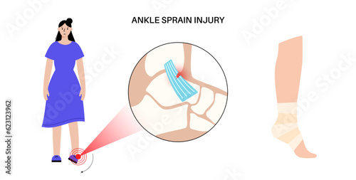 Sprained ankle injury