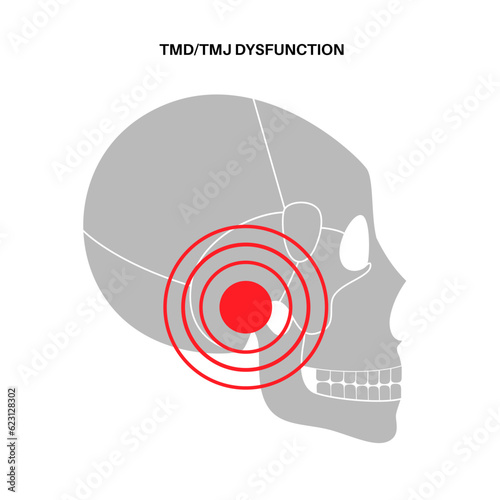 TMD TMJ disorder