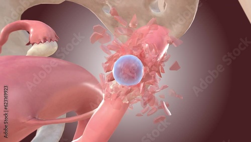 Ectopic pregnancy embryo causes tube rupture
