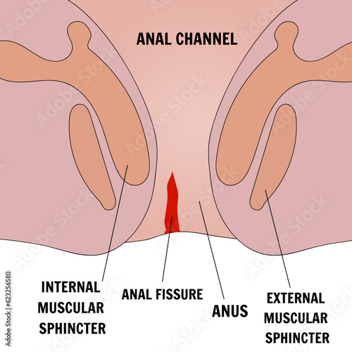 Anal fissure hemorrhoids disease in vector illustration 