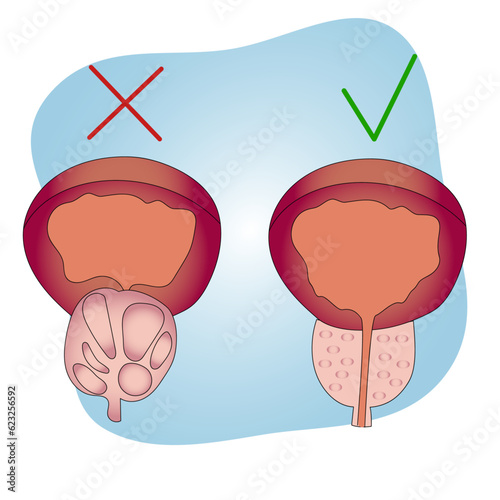 Medical infographic with male prostate problem