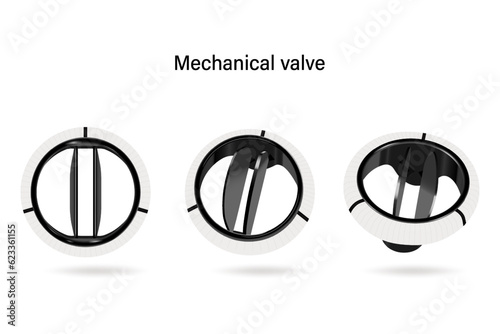 Mechanical valve vector. Aortic valve repair.