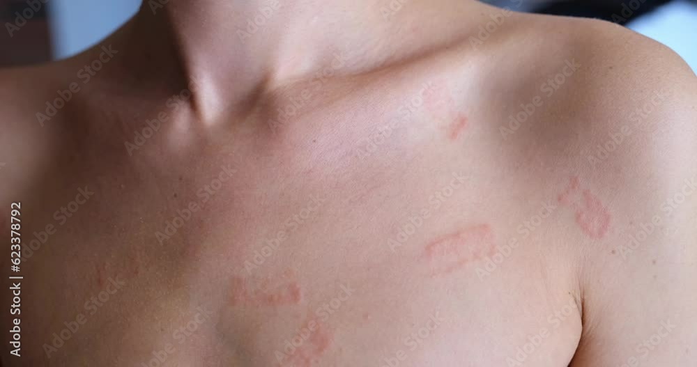 Random Red Rash On Chest A woman scratches a red rash on the white skin of her chest, close-up ...