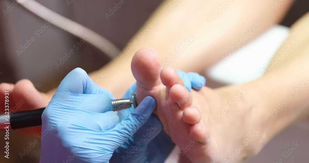 A pedicure master removes corns from a woman's legs, close-up. Cosmetic procedure in the salon, removal of erydermis A pedicure master removes corns from a woman's legs, close-up. Cosmetic procedure in the salon, removal of erydermis