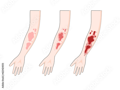 burn degree diagram schematic vector illustration. Medical science educational illustration