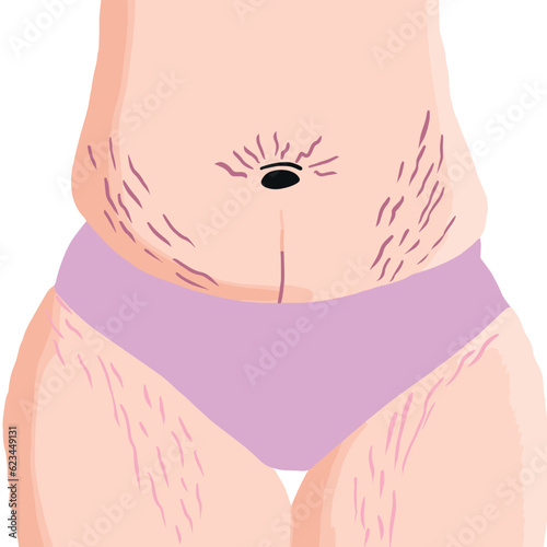 Belly with stretch marks. Striae after pregnancy. Overweight waist and legs. Postpartum Body in vector. Woman with fat in pink underwear.
