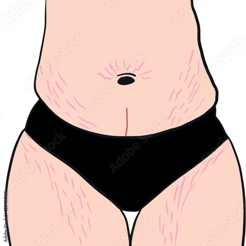Belly with stretch marks. Striae after pregnancy. Overweight waist and legs. Postpartum Body in vector. Woman with fat in black underwear.