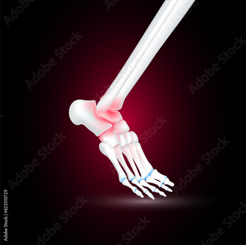 Ankle bone foot traumas and arthritis joint cartilage side on black background. Human skeleton anatomy healthy. Medical health care science concept. Realistic 3D vector.