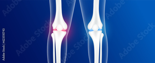 Bone healthy and osteoarthritis or degenerative joint disease. Arthritis knee joint pain within a leg. Cartilage becomes worn. This results in inflammation swelling. Human bone anatomy. Vector EPS10.