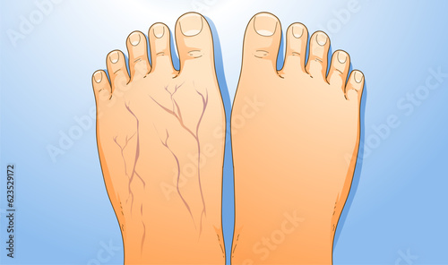 Human legs with health problems. Varicose veins. Before, after. Vector illustration. Healthcare illustration. 