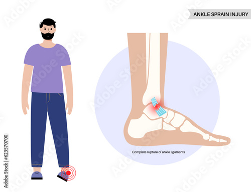 Sprained ankle injury