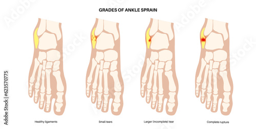 Sprained ankle injury