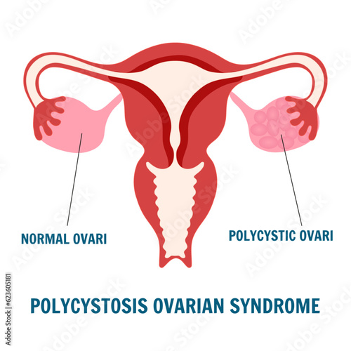 Polycystic ovarian syndrome in reproductive woman's system in vector illustration 