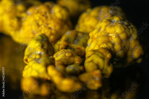 Gallstones,multiple cholesterol stone in gallbladder with cholecystitis. Gallbladder disease, stone formation. Cholecystectomy vs Laparoscopic Gallbladder Surgery for gallstones removal. photo