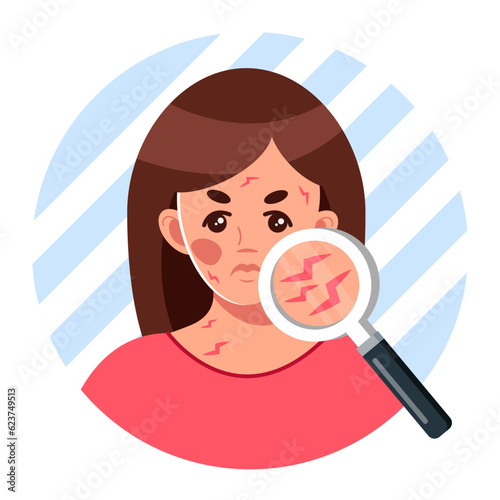 A young woman with dry skin on her face. A symptom of allergies, psoriasis. Itching, atopic dermatitis, eczema, dryness. A girl with a magnifying glass. Vector illustration in cartoon style