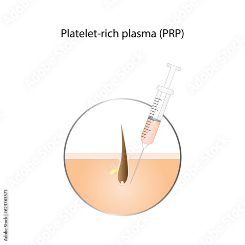 Platelet-rich plasma (prp), a concentrate of platelet-rich plasma extracted from whole blood. PRP treatment for rejuvenation and recovery of skin and hair. Syringe, hair follicle. Vector design.