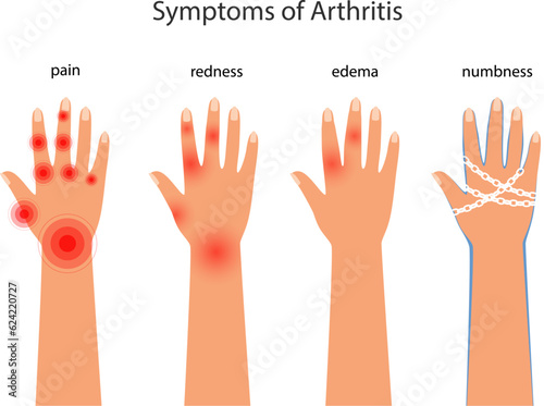 Symptoms of rheumatoid arthritis, redness, edema, numbness. Pain in the hands with autoimmune disease vector poster