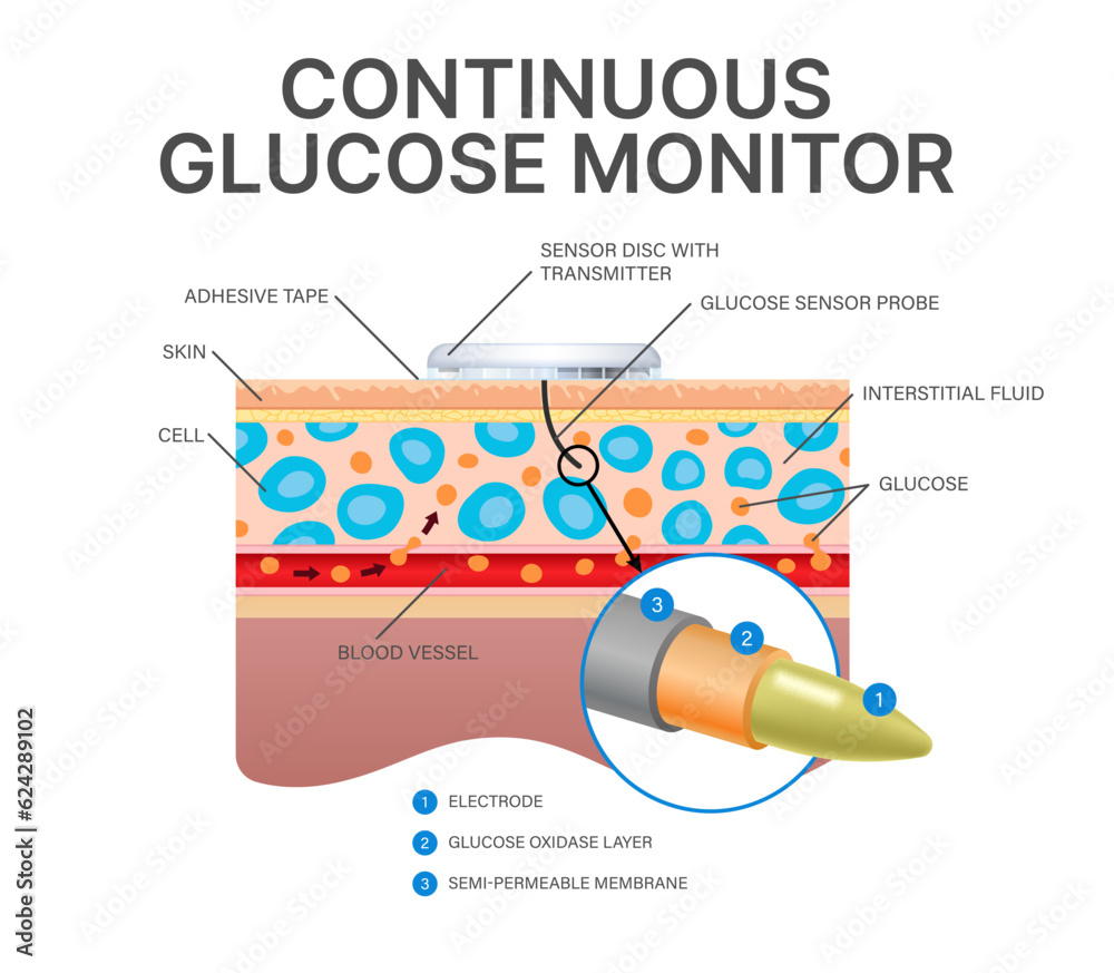 Continuous glucose sugar monitor. wireless transmeter. CGM