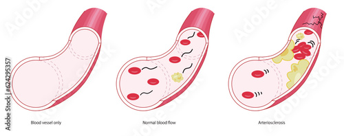 健康な血管、動脈硬化症の血管、ベクターイラスト