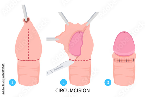 Herpes simplex virus and Circumcision paraphimosis for phimosis swelling pain with HSV and HPV Redness itchy prepuce Genital candidiasis yeast bacteria preputial adhesion Medical anatomy photo