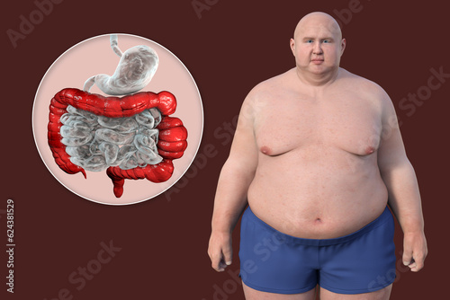 An overweight man with the presence of large intestine spasms associated with irritable bowel syndrome, 3D illustration