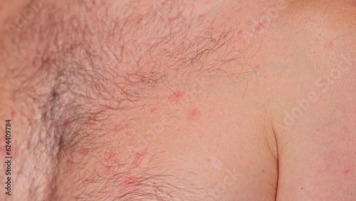 Man with acne, red spots, skin disease. Varicella or Herpes Zoster concept