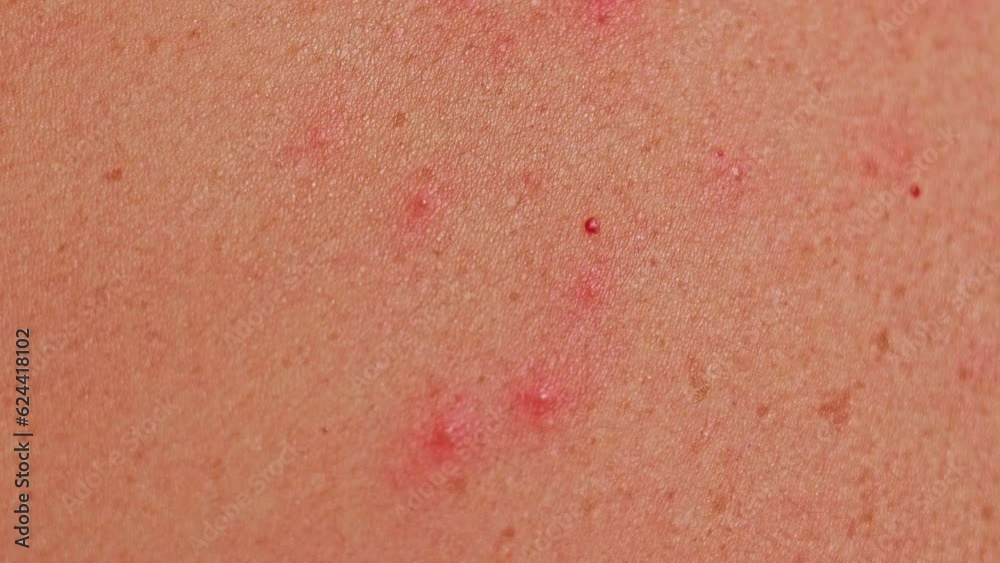 Man's back with acne, red spots, skin disease. Varicella or Herpes Zoster concept Man's back with acne, red spots, skin disease. Varicella or Herpes Zoster concept