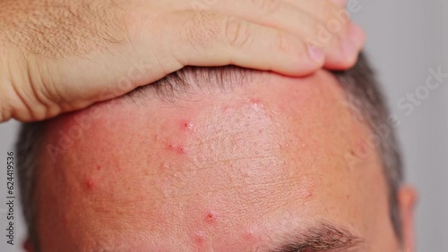 Man's forehead with acne, red spots, skin disease. Varicella or Herpes Zoster concept photo