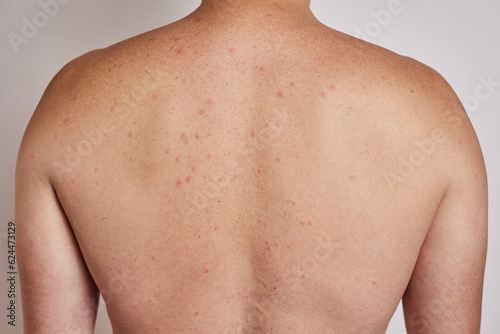 Man's back with acne, red spots, skin disease