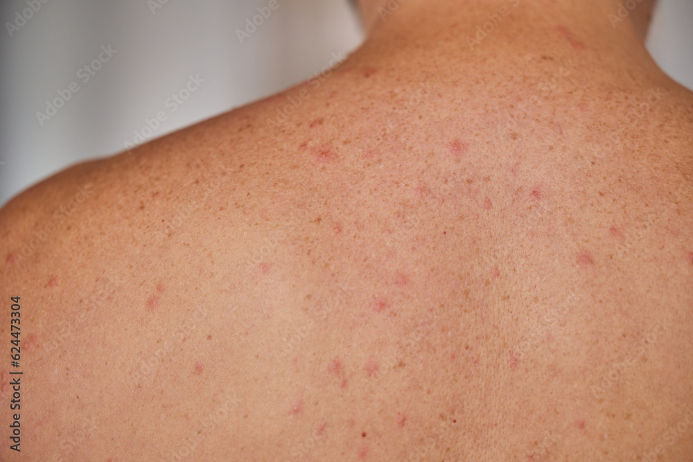 Man's back with acne, red spots, skin disease Man's back with acne, red spots, skin disease