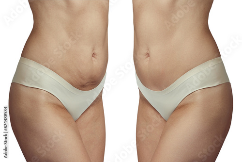 abdominoplasty before and after. Correction of sagging skin. Isolated on white background. photo
