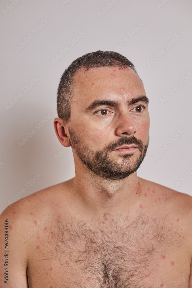 Obraz premium Man with acne, red spots, skin disease