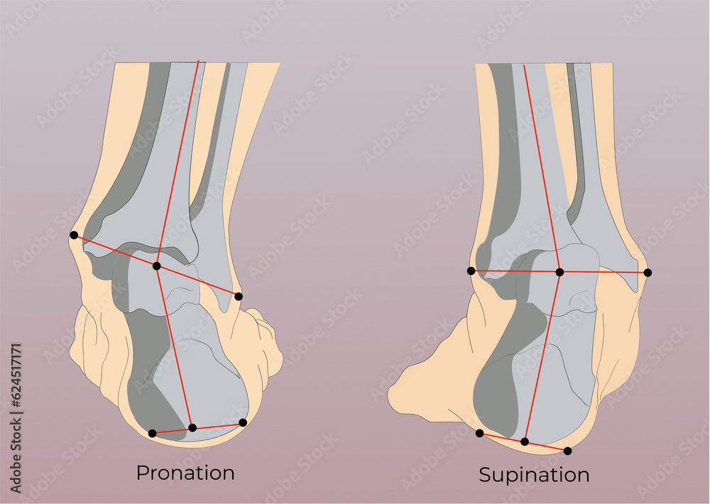 leg pronation