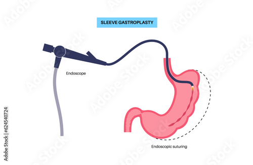 Endoscopic sleeve gastroplasty