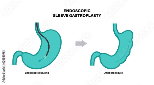 Endoscopic sleeve gastroplasty