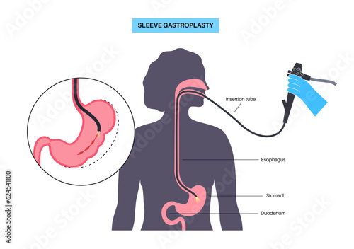 Endoscopic sleeve gastroplasty
