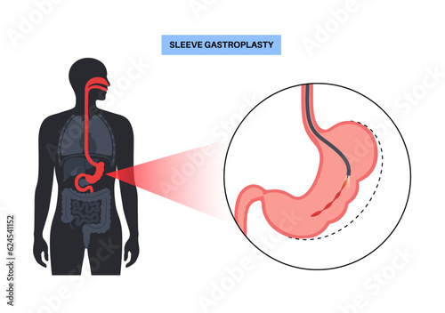 Endoscopic sleeve gastroplasty