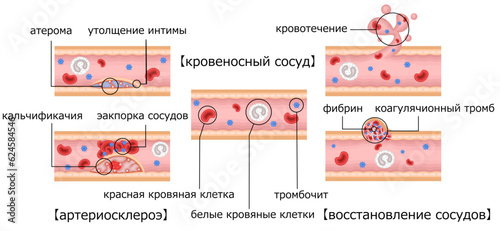 血管　動脈硬化　血管修復　イラスト　ロシア語