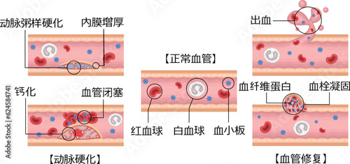血管　動脈硬化　血管修復　イラスト　中国語