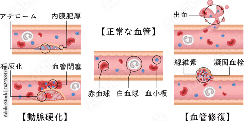 血管　動脈硬化　血管修復　イラスト