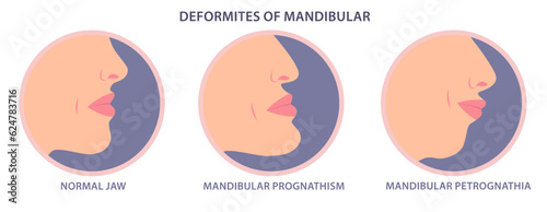 Deformities of mandibular vector illustration. Mandibular deficiency and excess. Jaw surgery and modification. Facial deficiency, midfacial problems. Jaw Deformity. maxillary prognathism correction.