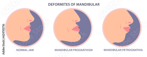 Deformities of mandibular vector illustration. Mandibular deficiency and excess. Jaw surgery and modification. Facial deficiency, midfacial problems. Jaw Deformity. maxillary prognathism correction. photo