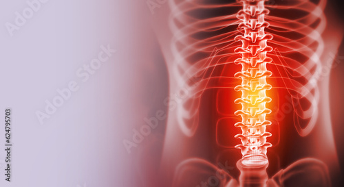 Schilderij op canvas pain in the spine, pain in the back, highlighted in red, x-ray view