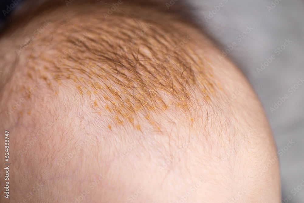 © HENADZY - Seborrheic dermatitis on the skin on the head of a 6 month old baby. Yellow scales on the head, close-up © HENADZY - Seborrheic dermatitis on the skin on the head of a 6 month old baby. Yellow scales on the head, close-up