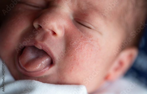 Pimples on the face of a newborn. Baby's adaptation to the environment, close-up photo